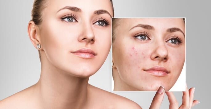 , Options for Acne Treatment